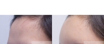 [이마] 우리엘 이마필러 시술 전 후