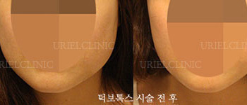 [보톡스] 턱보톡스 시술 전후