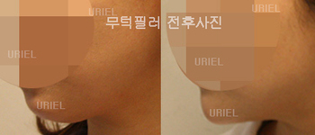 [귀족&무턱] 무턱필러 우리엘 시술전후