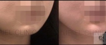 [귀족&무턱] 턱필러 시술 전 후