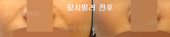 [귀족&무턱] 우리엘> 팔자필러 시술 전후사진