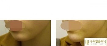 [귀족&무턱] 우리엘 턱필러 시술 전 후