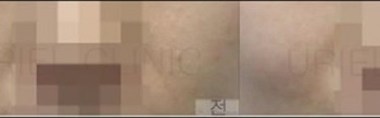 [피부] 여드름 치료 전 후 사진
