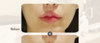 [입술] 필러성형센터 입술필러