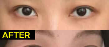 [눈밑&애교살] 필러성형센터 애교필러