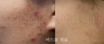 [피부] 우리엘>여드름치료