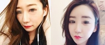 [풀페이스] 풀페이스 필러[우리엘] 시술 전 후