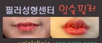 [입술] 입술필러