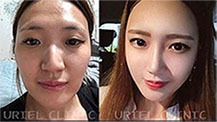 [풀페이스] 풀페이스 필러