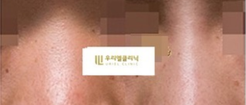 [코] 우리엘 코필러 시술 전 후