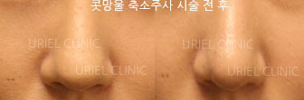 [보톡스] 우리엘 콧망울 주사 시술 전 후