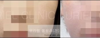 [볼&앞광대] 우리엘 볼필러 시술 전 후