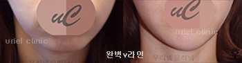 [완벽V라인] 완벽v라인 시술 전 후