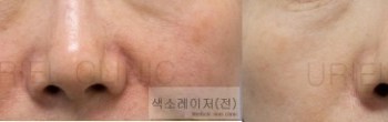 [피부] AIO색소레이저