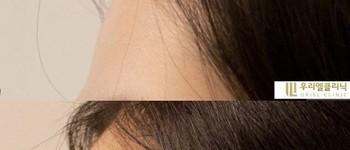[이마] 우리엘 이마필러 시술 전 후
