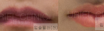 [입술] 우리엘 입술필러