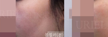 [볼&앞광대] 우리엘) 볼필러 전후사진