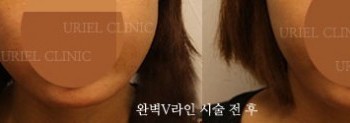 [완벽V라인] 완벽 V라인 시술 전 후