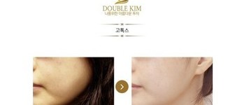 [보톡스] [우리엘/더블킴]보톡스 시술 전 후