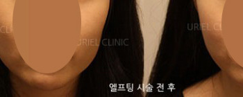 [리프팅] 우리엘 엘프팅 시술 전 후