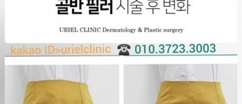 [바디클리닉] 골반필러