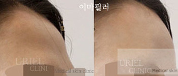 [이마] 우리엘) 이마필러 전후사진