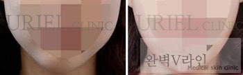 [완벽V라인] 우리엘) 완벽v라인 전후사진