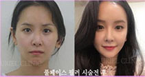 [풀페이스] 풀페이스 필러