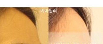 [이마] 이마필러 시술 전 후