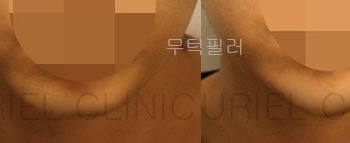 [귀족&무턱] 무턱필러 시술 전 후