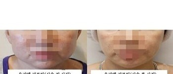 [리프팅] 우리엘 리프팅 시술 전 후