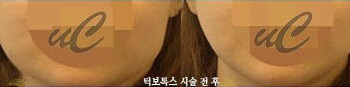 [보톡스] 우리엘 고톡스 시술 전 후