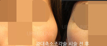 [라인업] 우리엘 광대축소조각술 시술 전 후