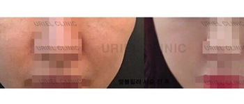 [볼&앞광대] 우리엘 볼 필러 시술 전 후