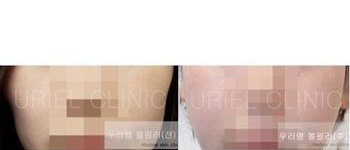 [볼&앞광대] 우리엘 볼필러 시술 전후