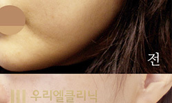 [보톡스] [우리엘] 고톡스 시술 전 후