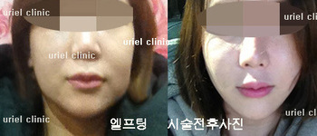 [리프팅&피부] 엘프팅 전후사진
