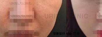 [볼&앞광대] [우리엘] 옆볼필러 시술 전 후
