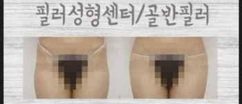 [바디클리닉] 골반필러