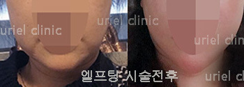 [리프팅] 우리엘 엘프팅 시술 전 후