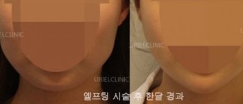 [리프팅] 우리엘 엘프팅 시술 전 후