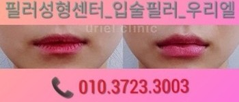 [입술] 입술필러(우리엘 클리닉)