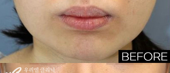 [리프팅] 민트실리프팅+테스리프팅 시술전후