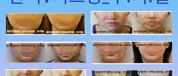 [완벽V라인] 완벽 V 라인