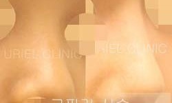 [코] 코필러 시술 전 후