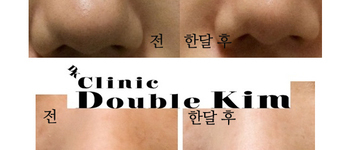 [보톡스] [우리엘/더블킴] 콧망울+콧볼 시술 전후