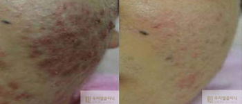[리프팅&피부] 우리엘 올인원레이저 시술 전 후