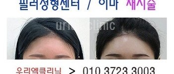 [이마] 이마필러 재시술