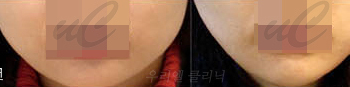 [보톡스] 보톡스[우리엘] 시술 전 후