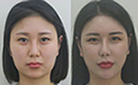 [풀페이스] 풀페이스 필러